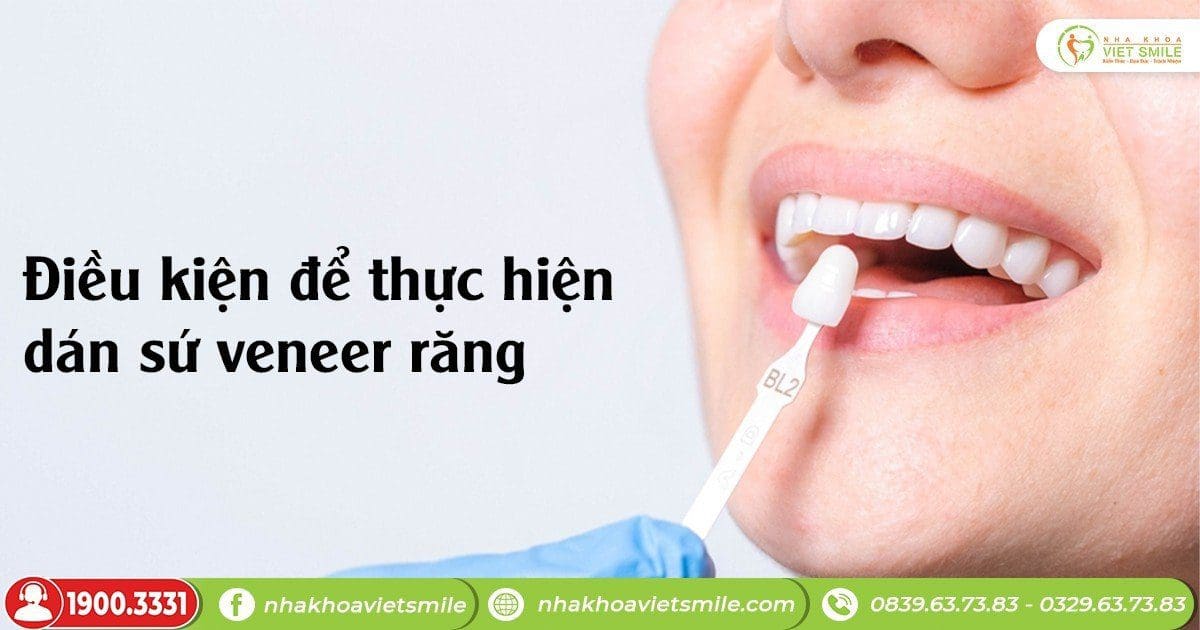 Điều kiện để thực hiện dán sứ veneer răng