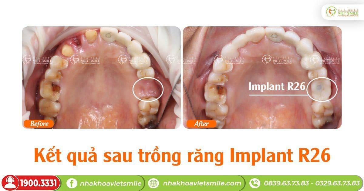 Kết quả sau trồng răng implant r26