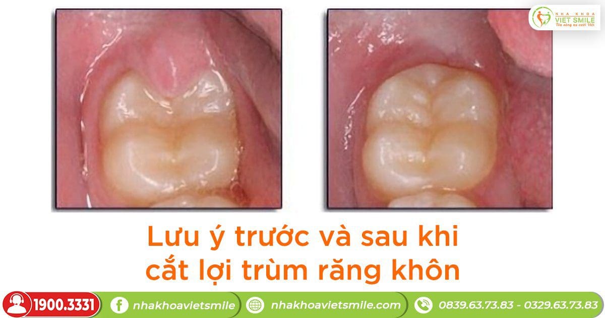 Lưu ý trước và sau khi cắt lợi trùm răng khôn