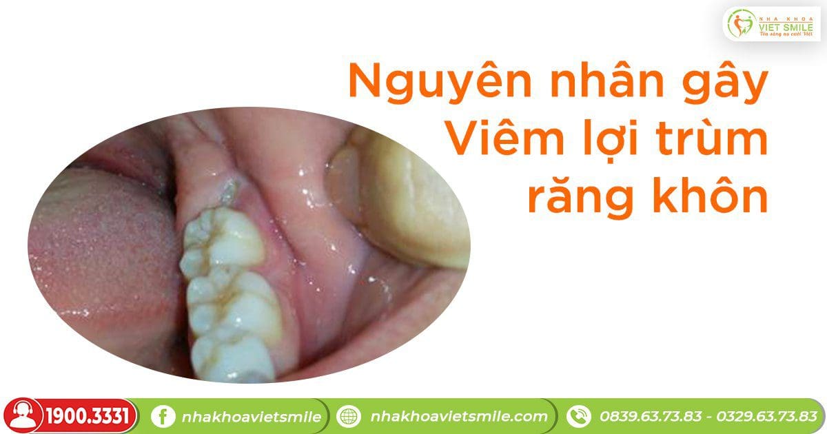 Nguyên nhân gây Viêm lợi trùm răng khôn