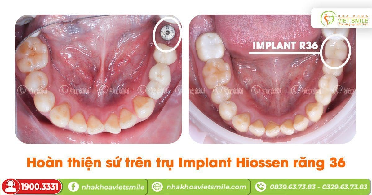 Trồng implant Hiossen răng 36