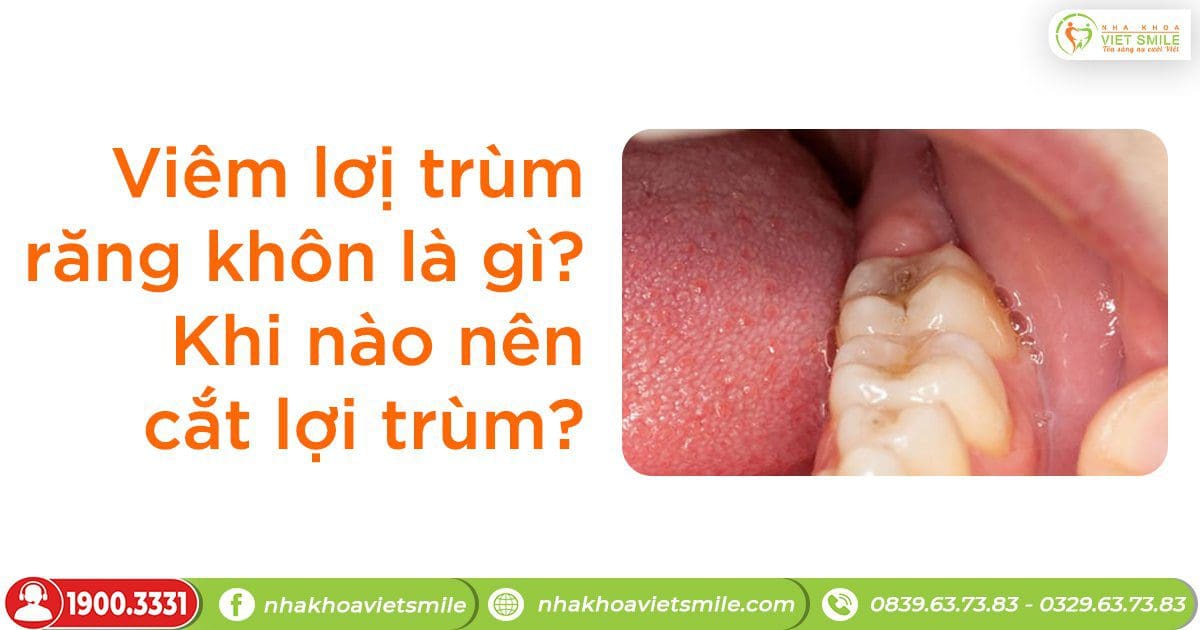 Viêm lợi trùm răng khôn là gì? Khi nào nên cắt lợi trùm?