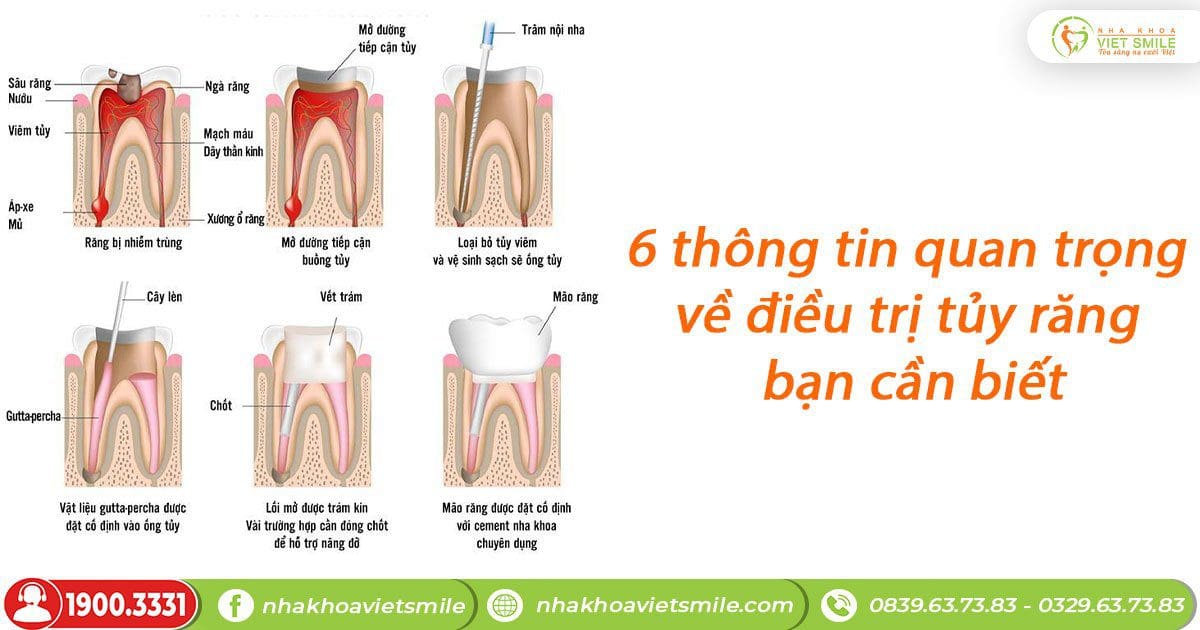 6 Thông tin quan trong về điều trị tủy răng bạn nên biết