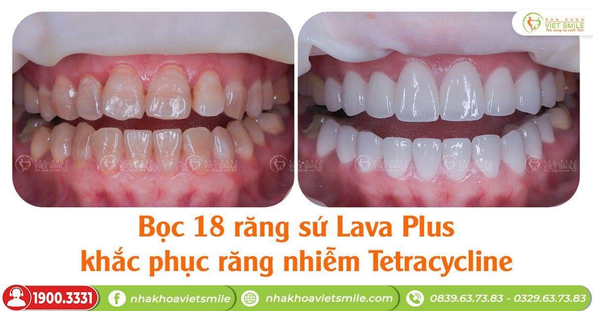 Bọc 18 răng sứ lava plus khắc phục răng nhiễn tetracycline