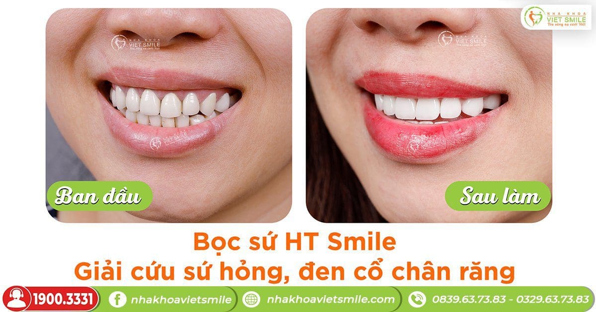Bọc 20 răng sứ ht smile khắc phục răng sứ bị hỏng, viêm lợi