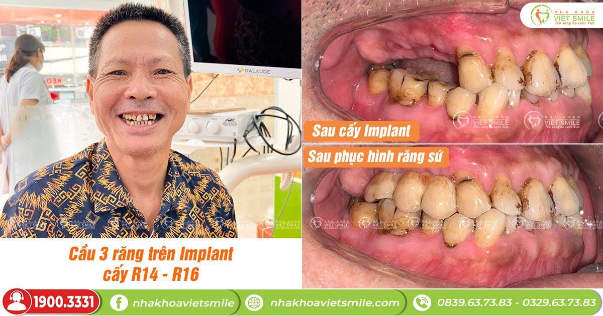 Cầu 3 răng trên implant -  cấy răng 14 và răng 16