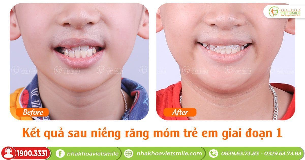 Kết quả sau niềng răng móm trẻ em giai đoạn 1