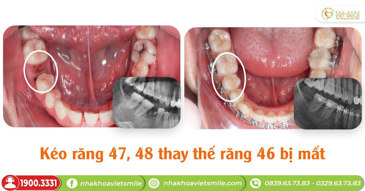 Mất răng 6, niềng kéo răng 7,8 thay thế được không? – KH Nông Tường Vy HN5628