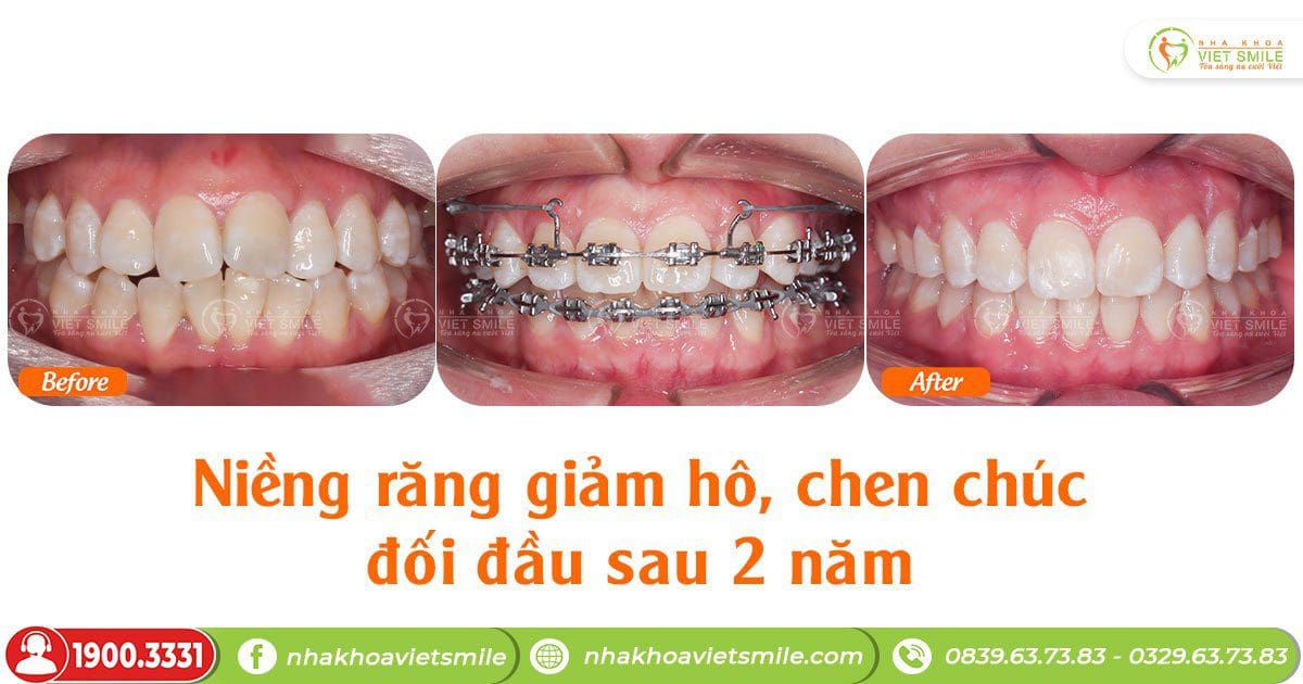 Niềng răng cải thiện răng hô, chen chúc sau 2 năm