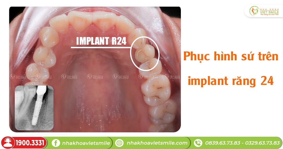 Phuc hinh implant