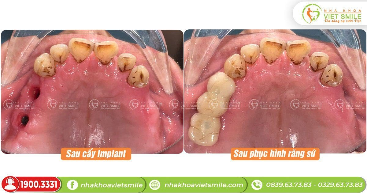 Phục hình răng mất sau cấu implant