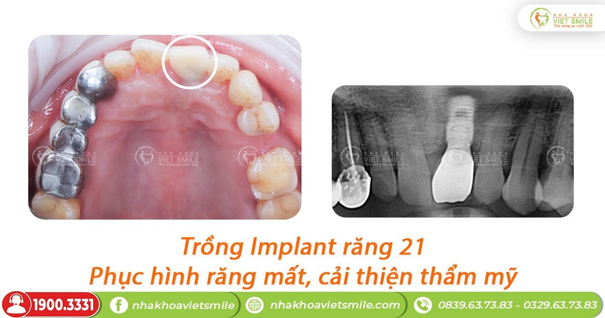 Kết quả sau quá trình cấy implant phục hình răng cửa 21 bị mất