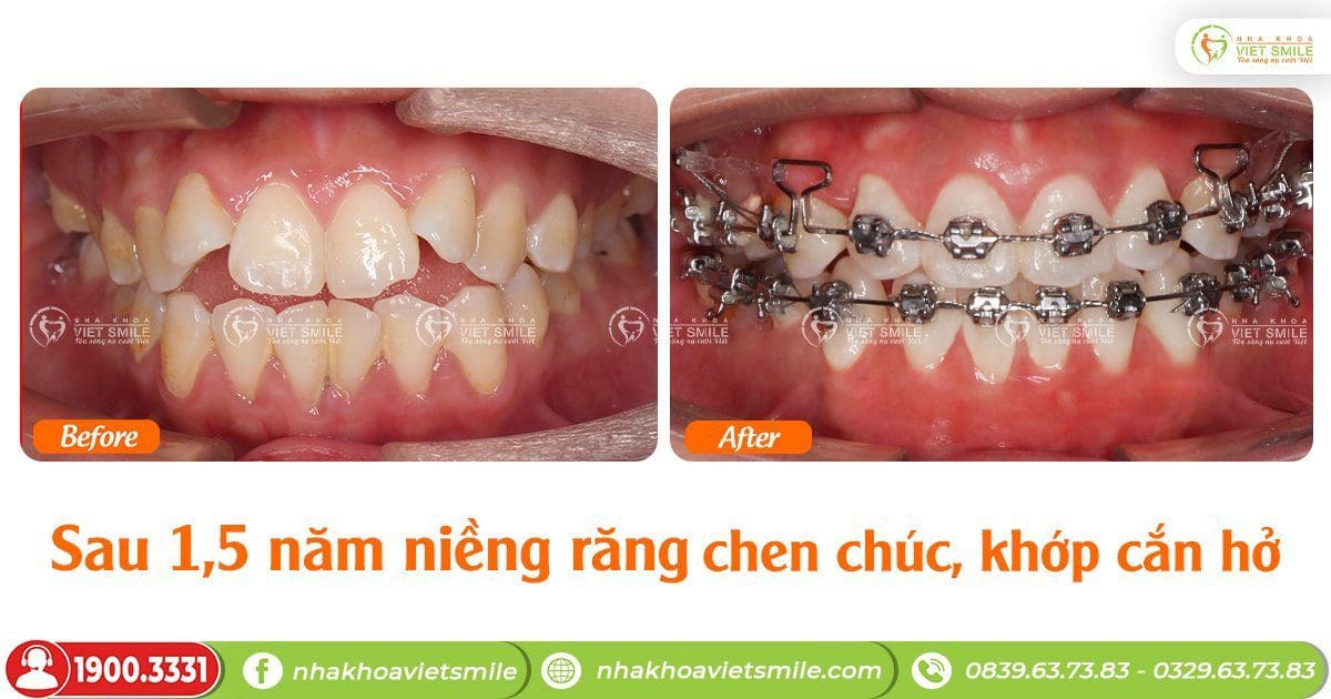 Cảm nhận sau 1,5 năm niềng răng chen chúc, cắn hở - kh. Lê thùy linh hn6066 1 Sau 1,5 năm niềng răng chen chúc, khớp cắn hở