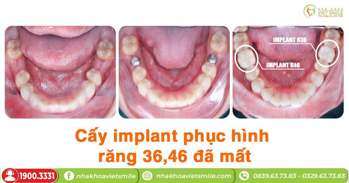 Cấy implant phục hình răng 36,46 đã mất