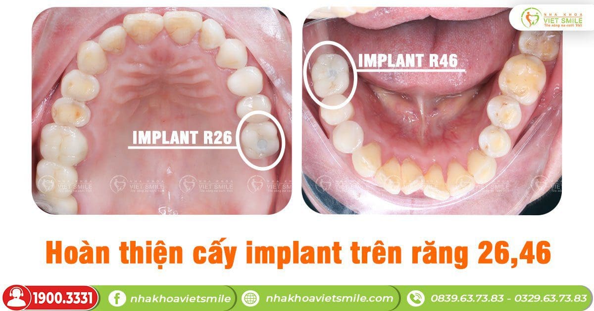 Hoàn thiện cấy implant trên răng 26,46
