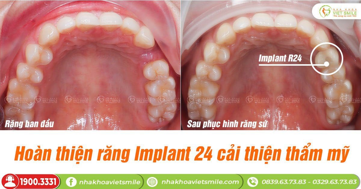 Hoàn thiện răng implant 24 cải thiện thẩm mỹ