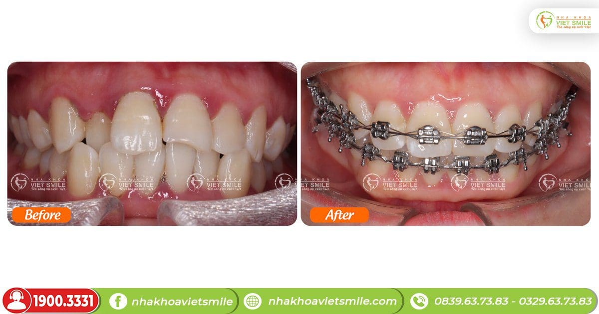 Trước và sau 10 tháng niềng răng