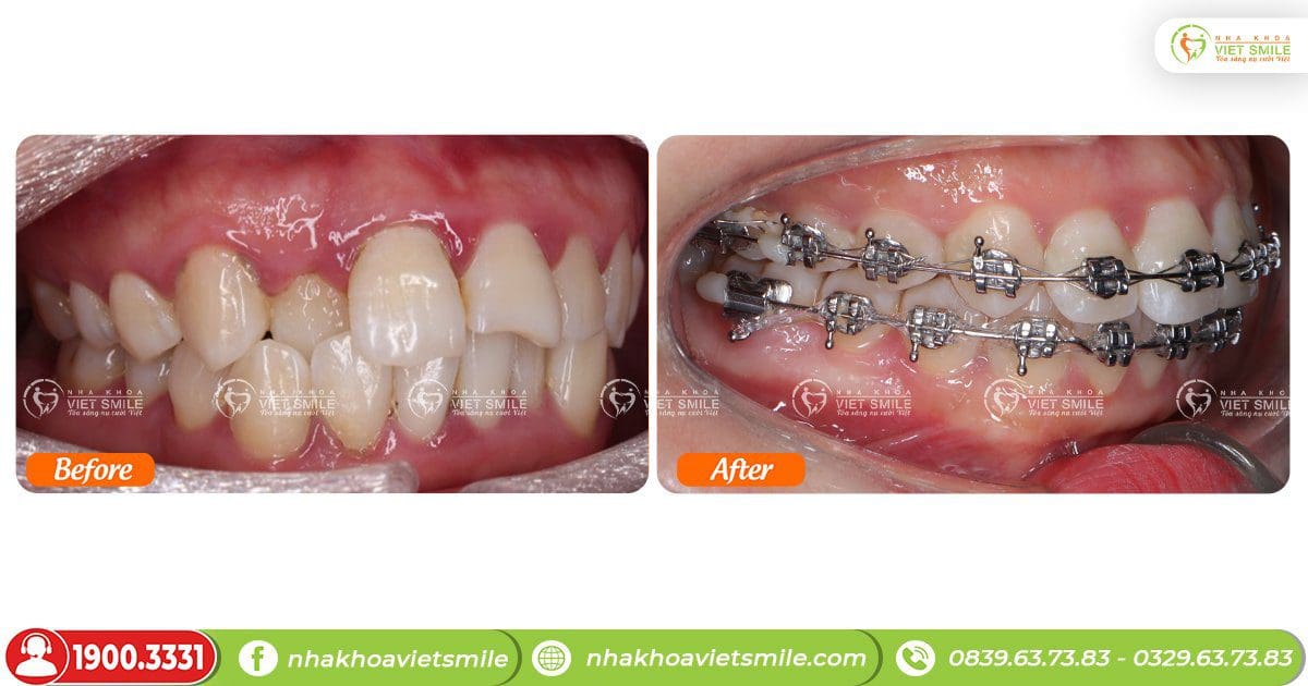 Trước và sau 10 tháng niềng răng góc nghiêng