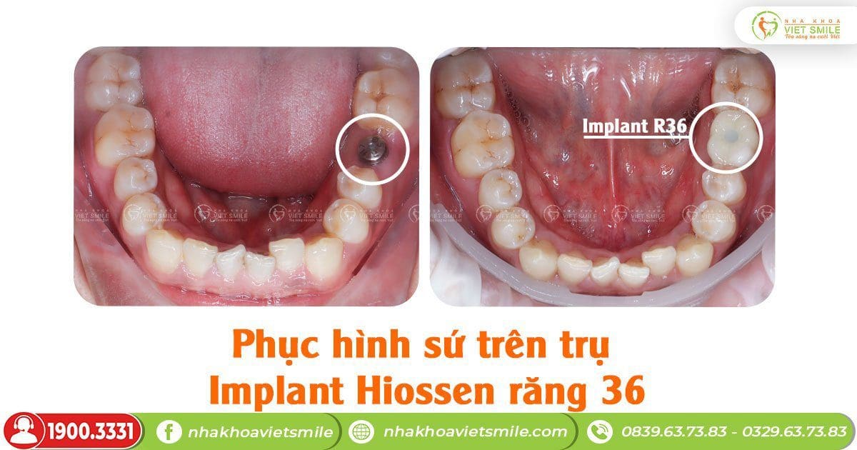 Phục hình sứ trên trụ implant hiossen răng 36