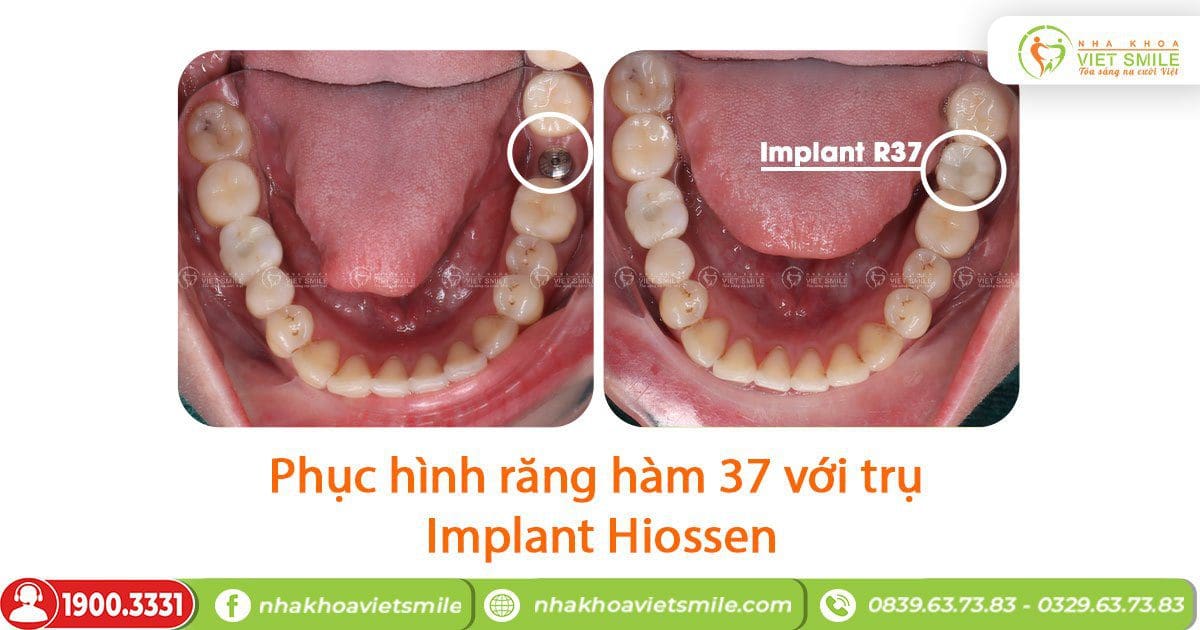 Cấy ghép implant hiossen phục hình răng hàm đã mất