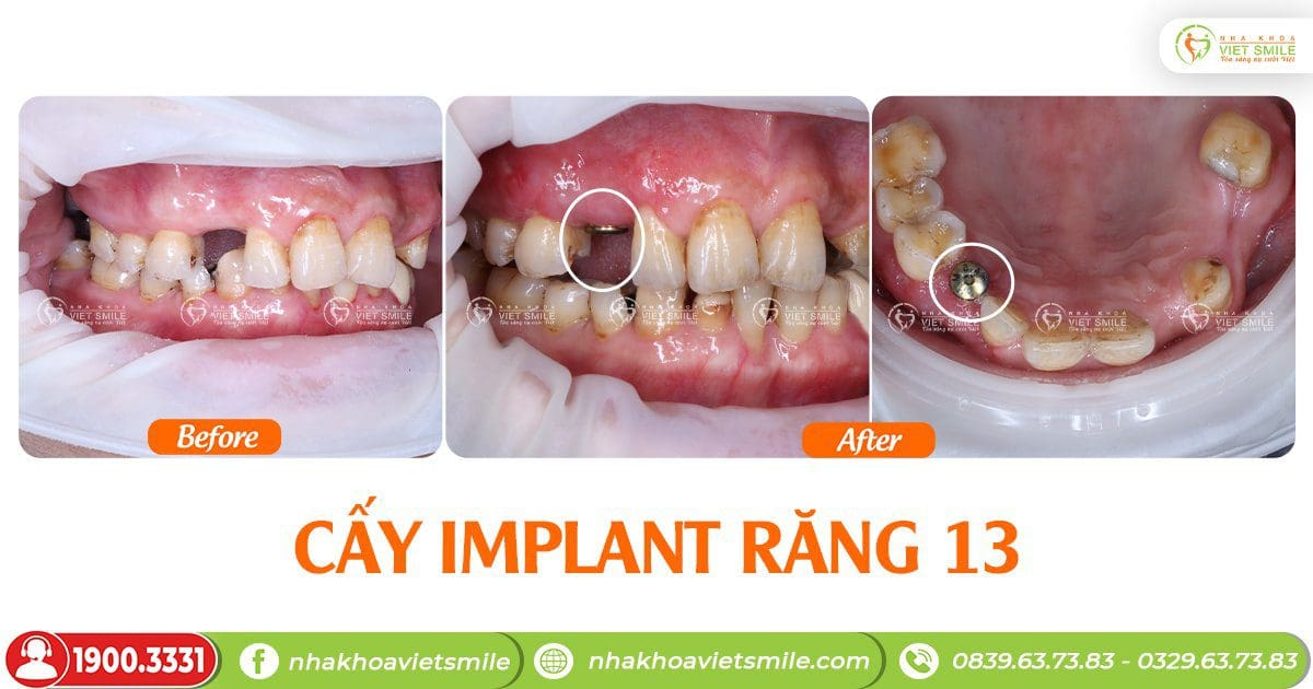 Trong implant 1