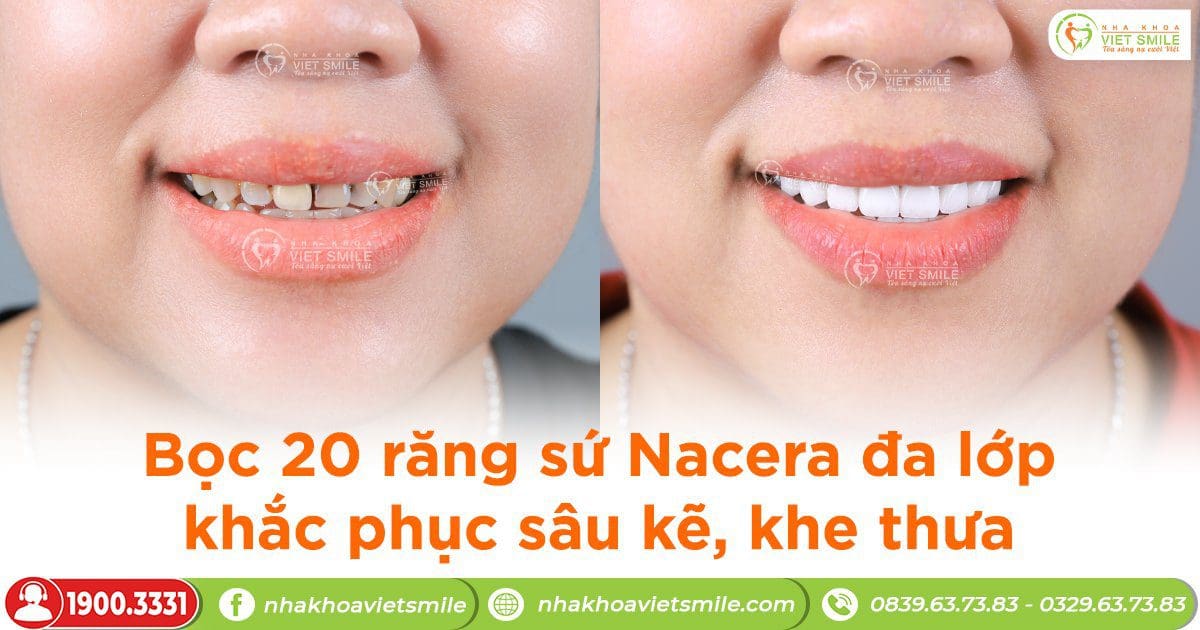 Bọc 20 răng sứ Nacera đa lớp khắc phục răng bị sâu kẽ