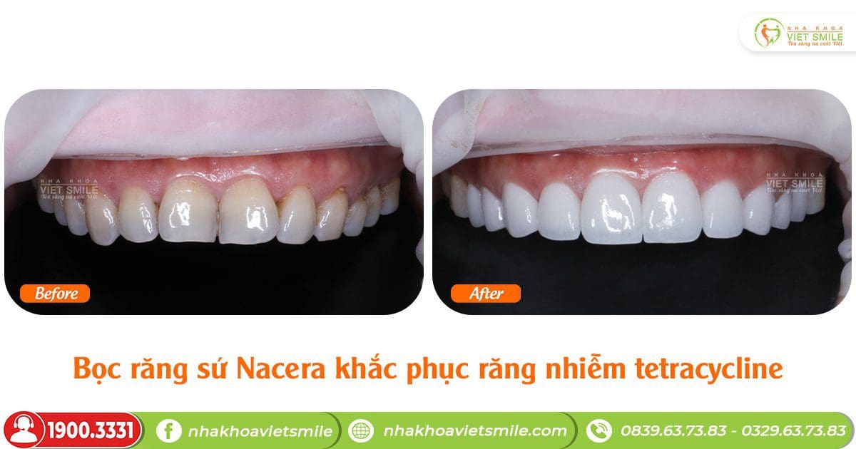 Bọc răng sứ Nacera khắc phục răng nhiễm tetracycline