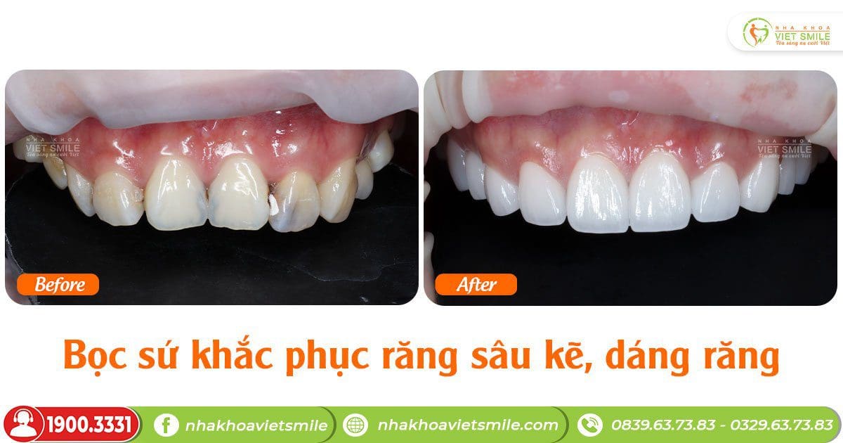 Bọc sứ khắc phục răng sâu kẽ, cải thiện dáng răng