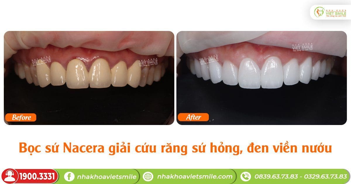 Trước và sau khi đến việt smile bọc răng sứ