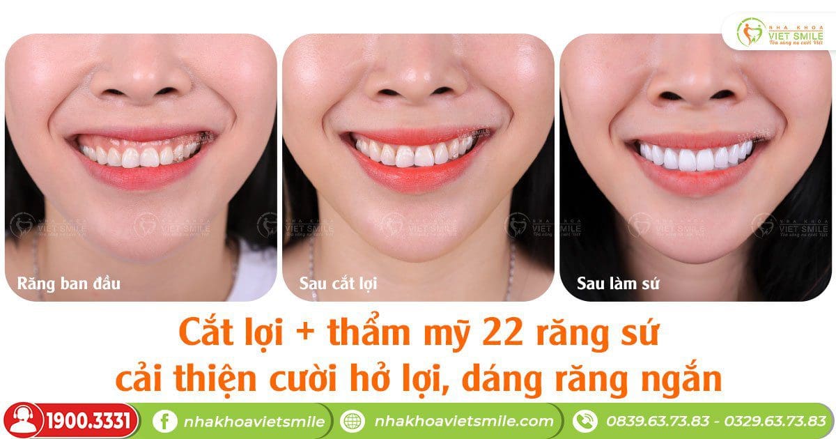 Cắt lợi kết hợp bọc răng sứ điều trị cười hở lợi, thẩm mỹ nụ cười