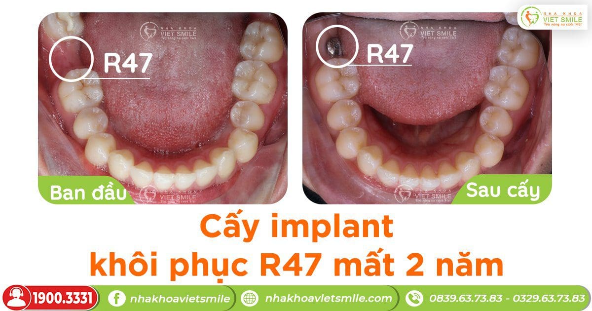 Cấy implant khôi phục răng 47 mất cách đây 2 năm