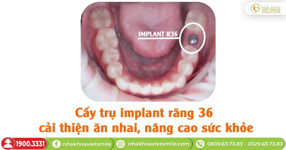 Cấy implant khôi phục răng mất cải thiện ăn nhai, nâng cao sức khỏe