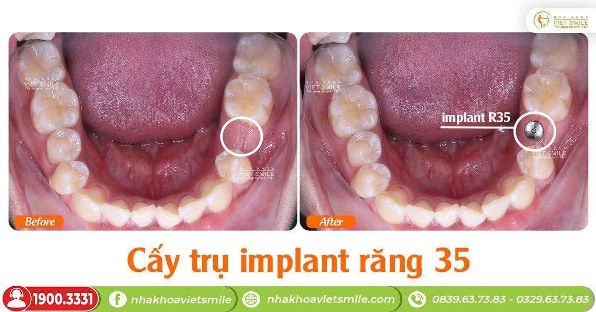Cấy trụ implant răng 35