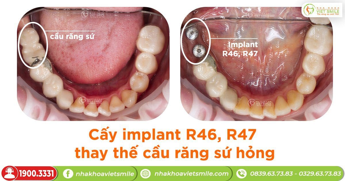 Cấy implant răng 46,47 thay thế cầu răng sứ hỏng