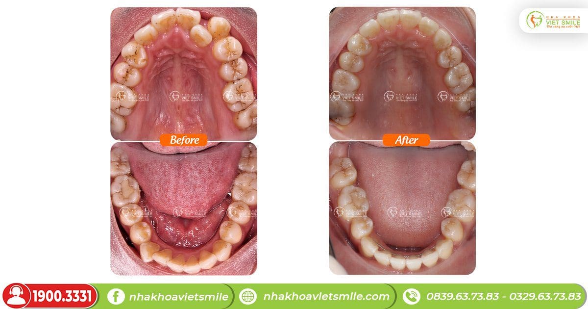 Cung răng tròn đều, hết chen chúc sau tháo mắc cài