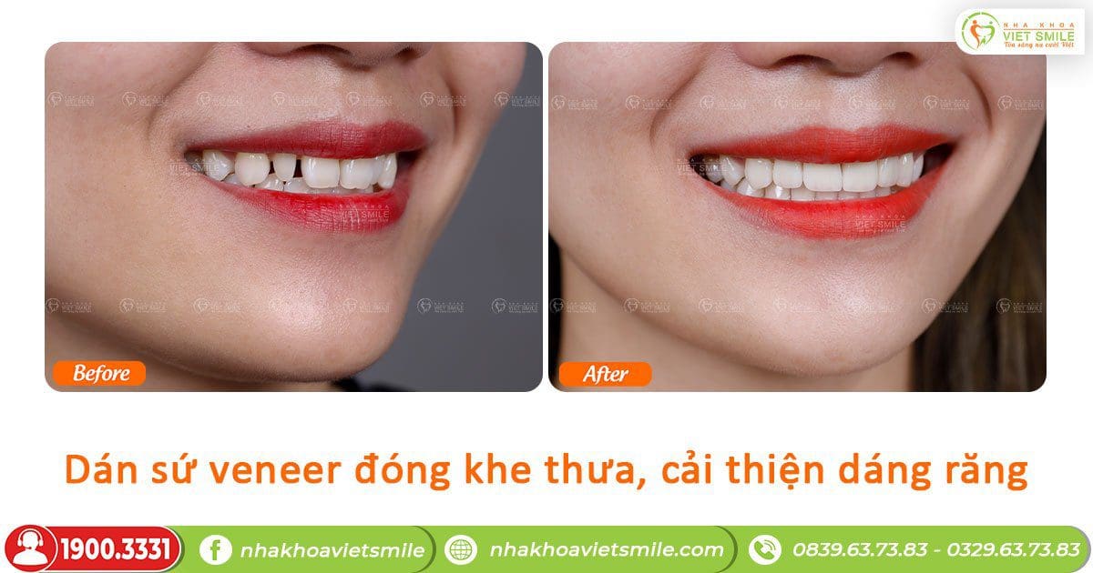 Dán sứ veneer khắc phục răng thưa, cải thiện dáng răng