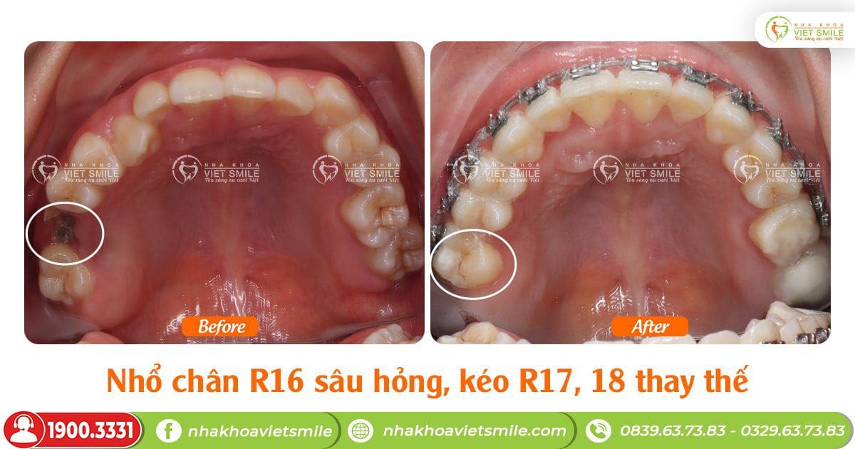 Niềng kéo răng 7,8 thay thế răng 6 sâu hỏng