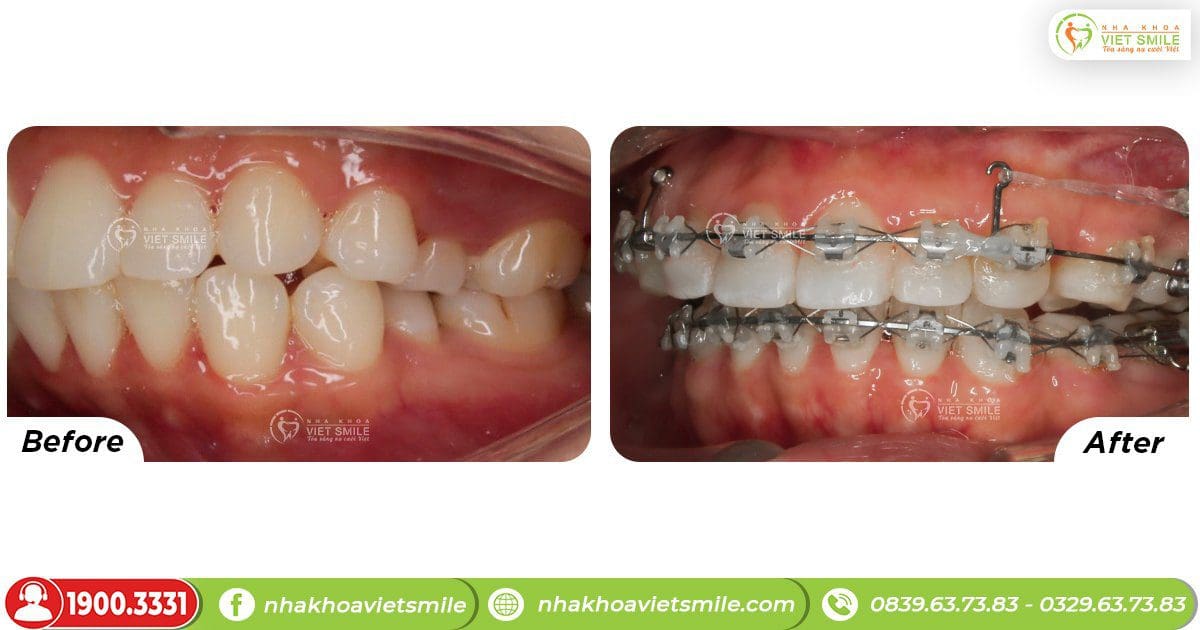 Trước và sau khi niềng răng tại Việt Smile góc nghiêng
