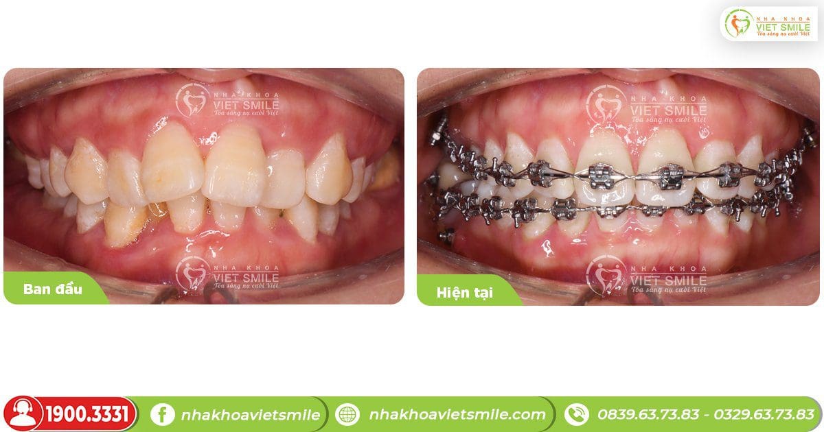 Trước và sau khi niềng răng hô tại Việt Smile