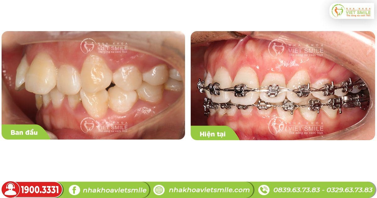 Trước và sau khi niềng răng hô tại Việt Smile - góc nghiêng trái