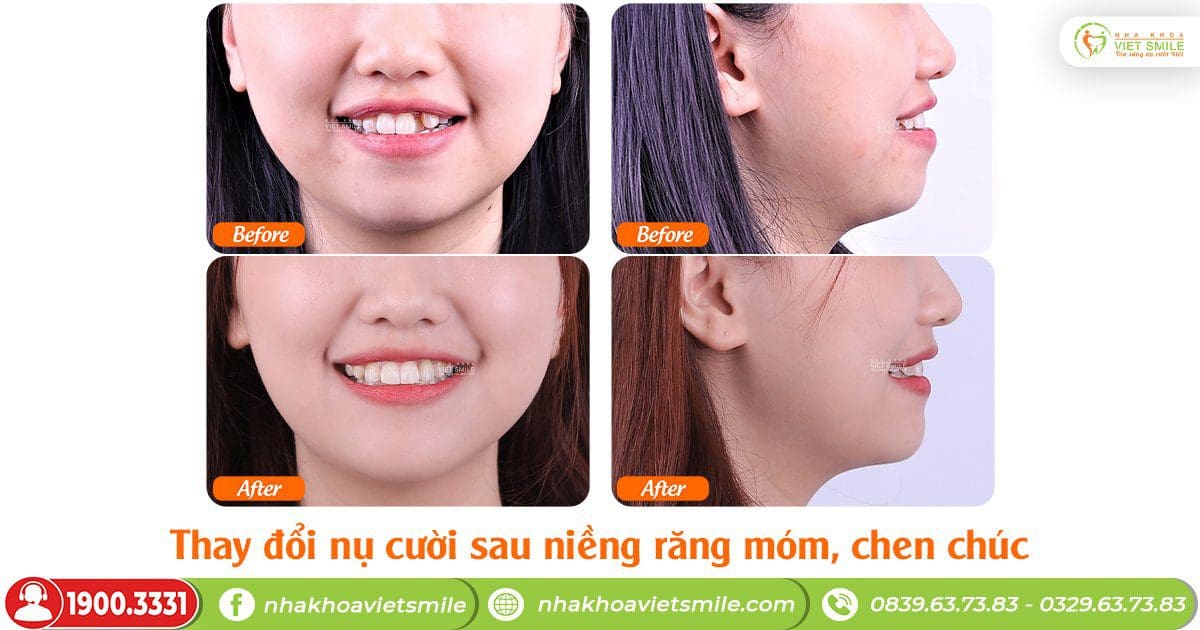 Niềng răng móm cải thiện góc nghiêng, cho nụ cười xinh