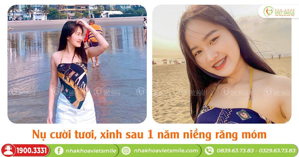 Nụ cười xinh sau 1 năm niềng răng móm