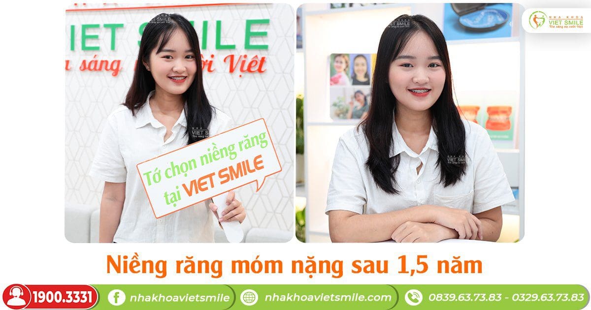 Nụ cười xinh, tự tin sau 1,5 năm niềng răng