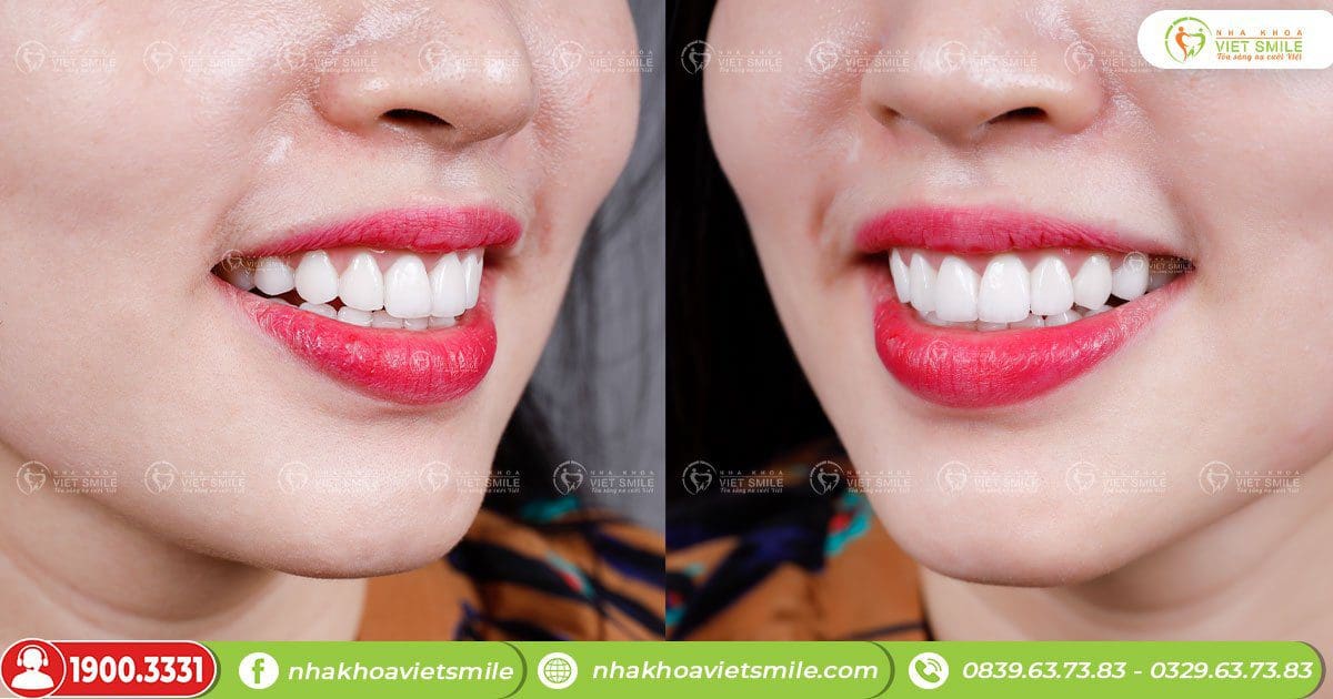 Răng trắng sáng tự nhiên sau làm răng sứ thẩm mỹ