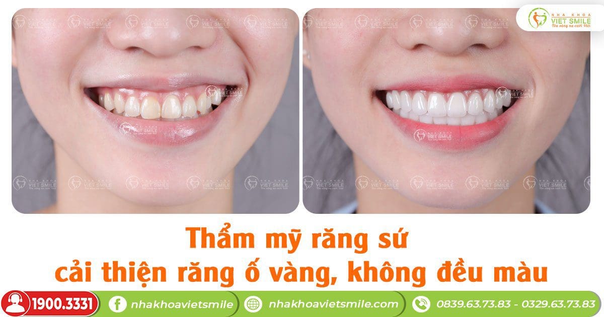 Thẩm mỹ răng sứ cải thiện răng ô vàng, không đều màu
