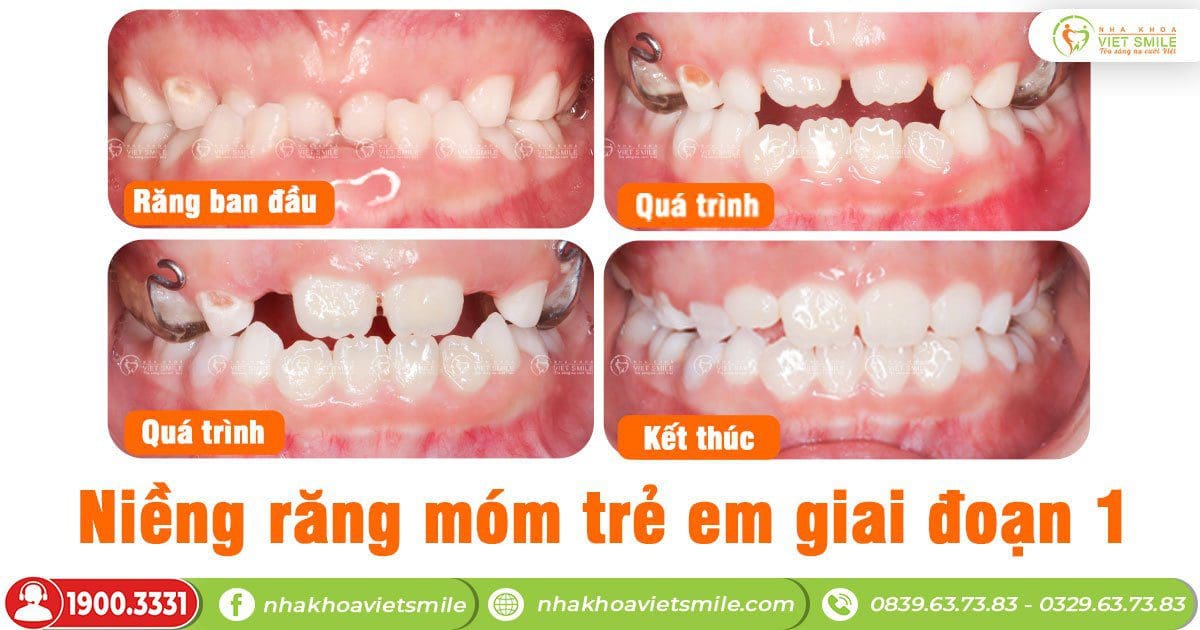 Khớp cắn cải thiện theo từng giai đoạn niềng răng móm trẻ em