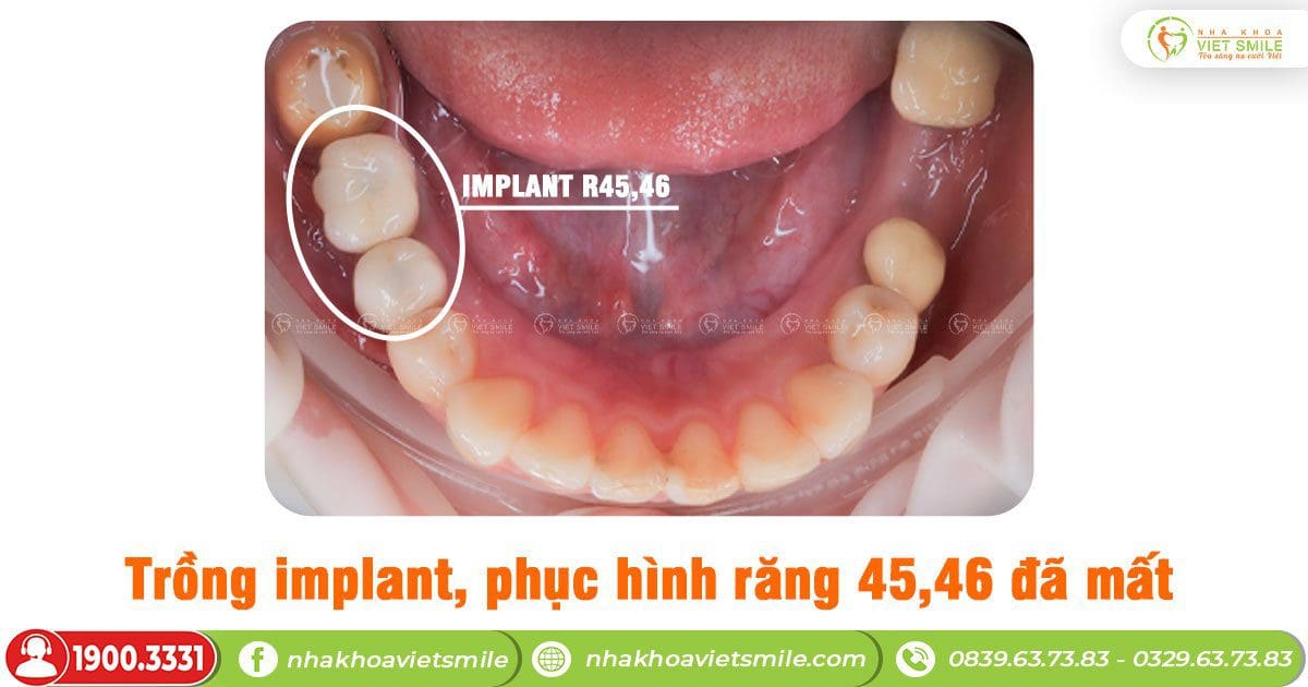 Trong implant