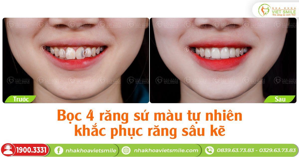 Bọc 4 răng sứ màu tự nhiên khắc phục răng sâu kẽ