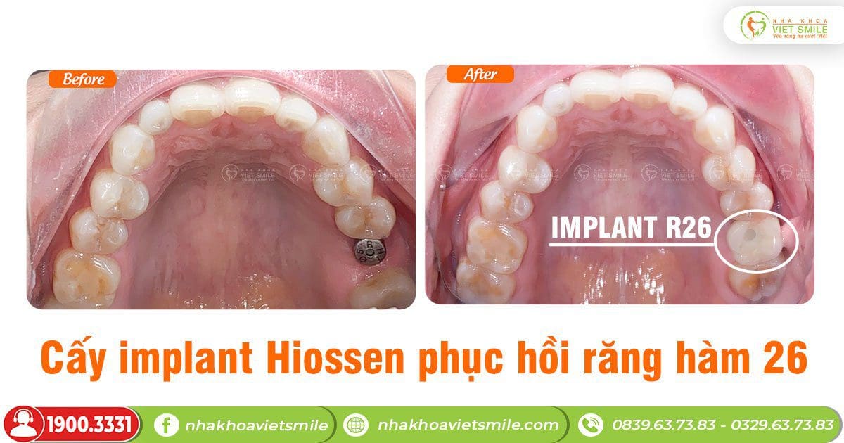 Cấy implant hiossen răng hàm 26, ăn nhai thoải mái