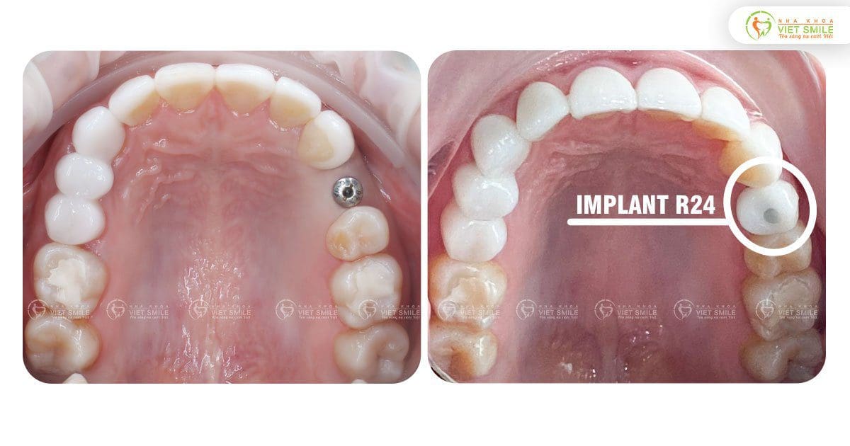 Cấy implant khôi phục răng 24 mất ăn nhai trọn vẹn